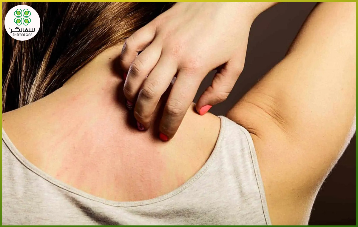 عرق‌سوز شدن پوست چیست؟ علائم، علت‌ها، روش‌های درمان و پیشگیری